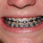 Creating a new smile